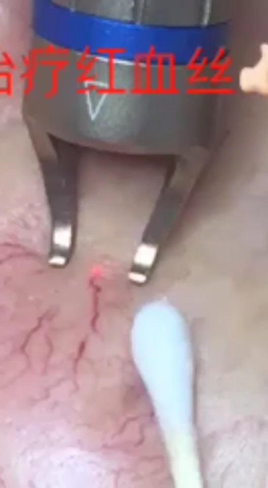 湖南珈黛治疗红血丝